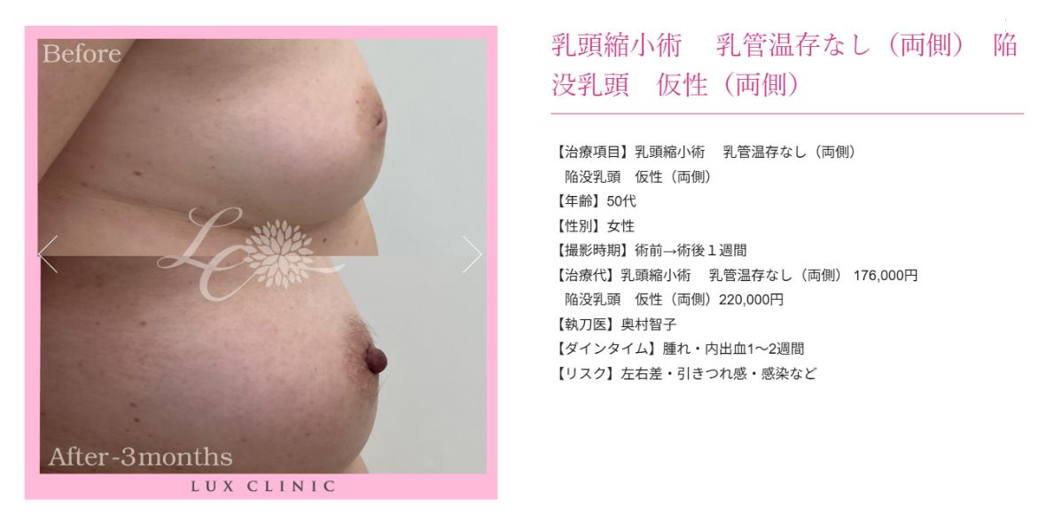 乳頭縮小術 陥没乳頭