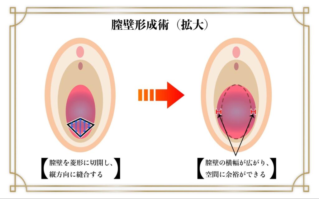 膣壁形成術 膣の締まり 治療法