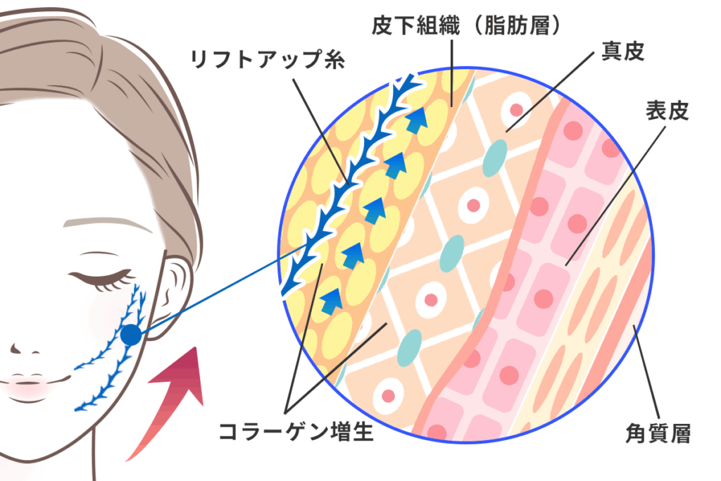 糸リフトに期待できる主な効果