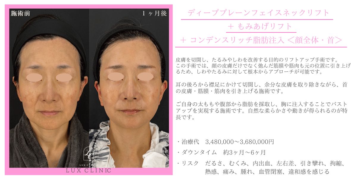 ディーププレーンフェイスネックリフト もみあげリフト コンデンスリッチ脂肪注入