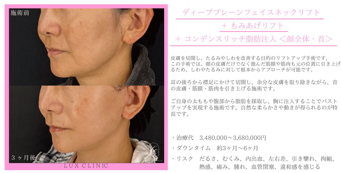 ディーププレーンフェイスネックリフト もみあげリフト コンデンスリッチ脂肪注入