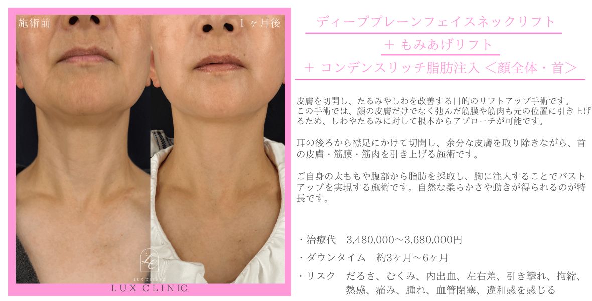 ディーププレーンフェイスネックリフト もみあげリフト コンデンスリッチ脂肪注入