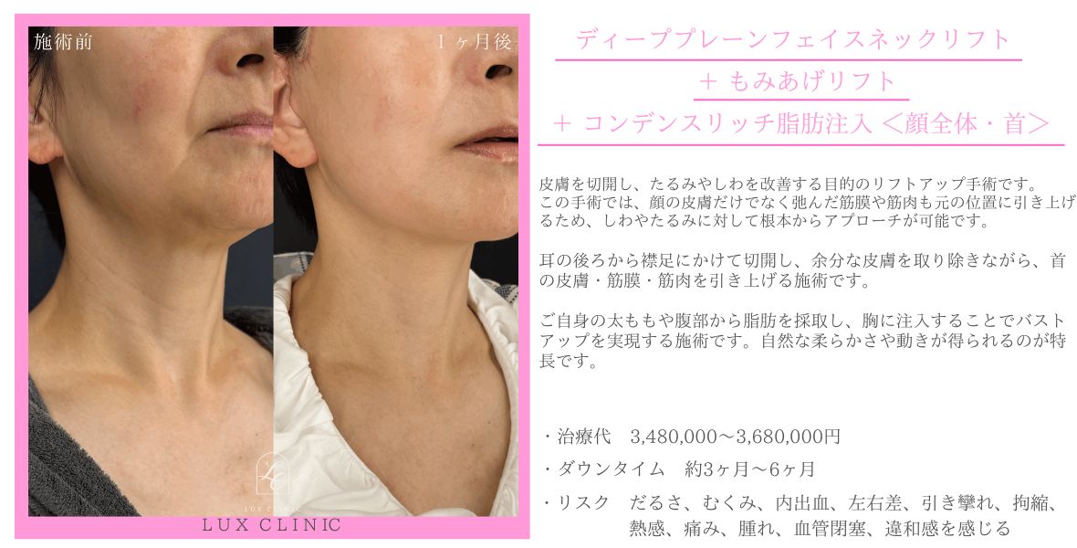 ディーププレーンフェイスネックリフト もみあげリフト コンデンスリッチ脂肪注入