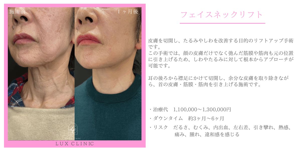 フェイスネックリフト