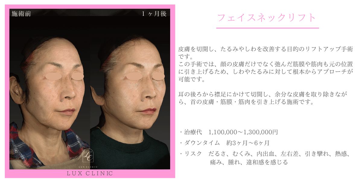 フェイスネックリフト