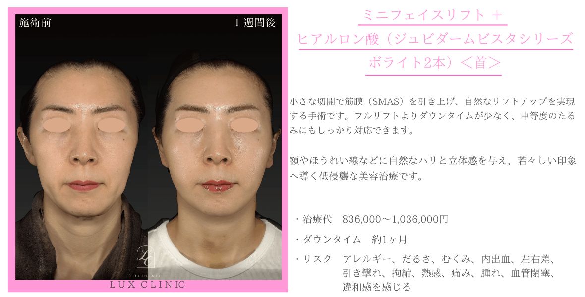 ミニフェイスリフト ヒアルロン酸 ジュビダームビスタシリーズ ボライト