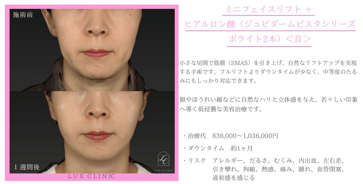 ミニフェイスリフト ヒアルロン酸 ジュビダームビスタシリーズ ボライト