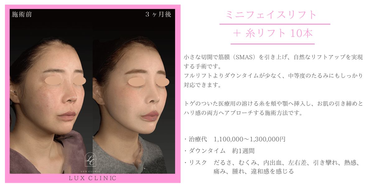 ミニフェイスリフト 糸リフト