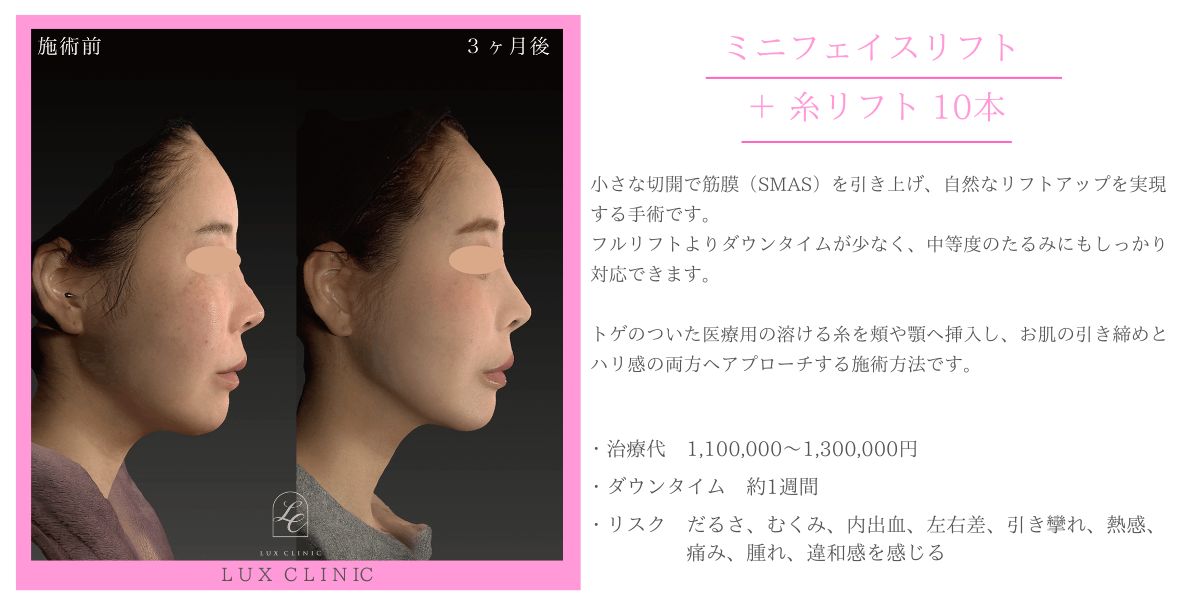 ミニフェイスリフト 糸リフト