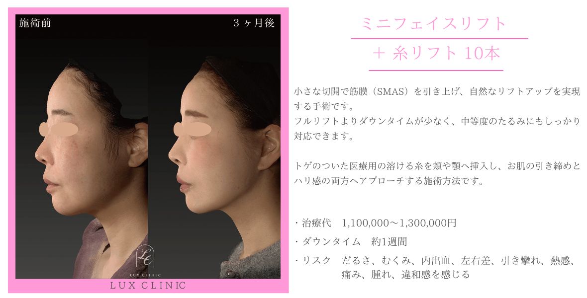 ミニフェイスリフト 糸リフト