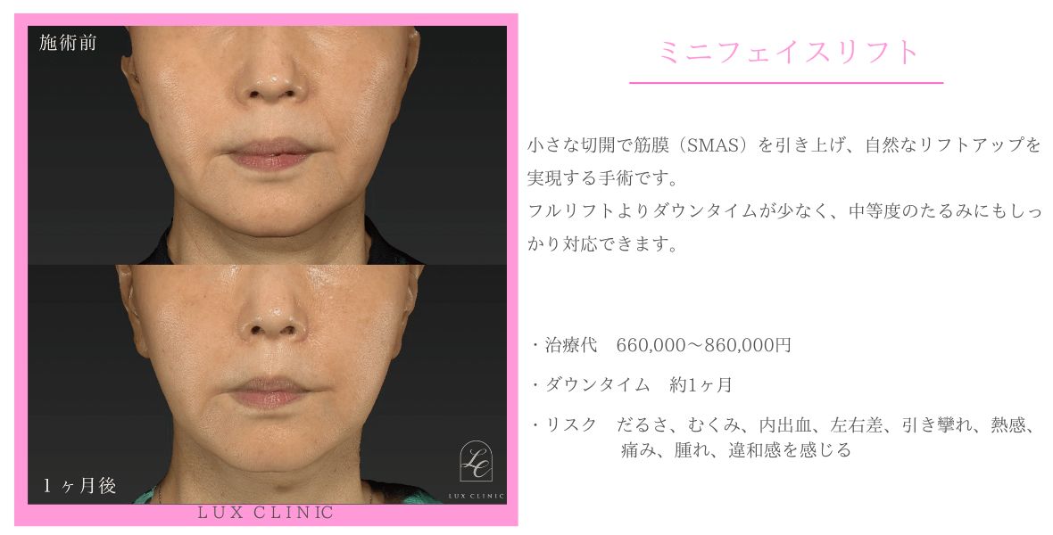 ミニフェイスリフト