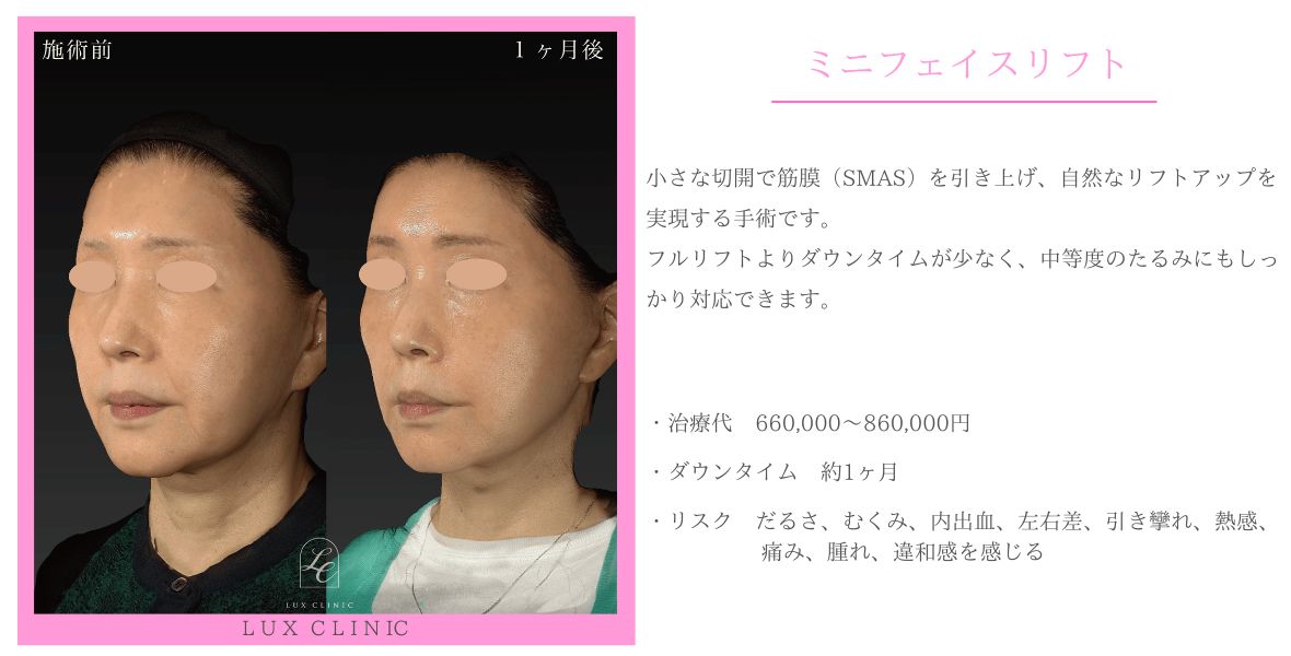 ミニフェイスリフト