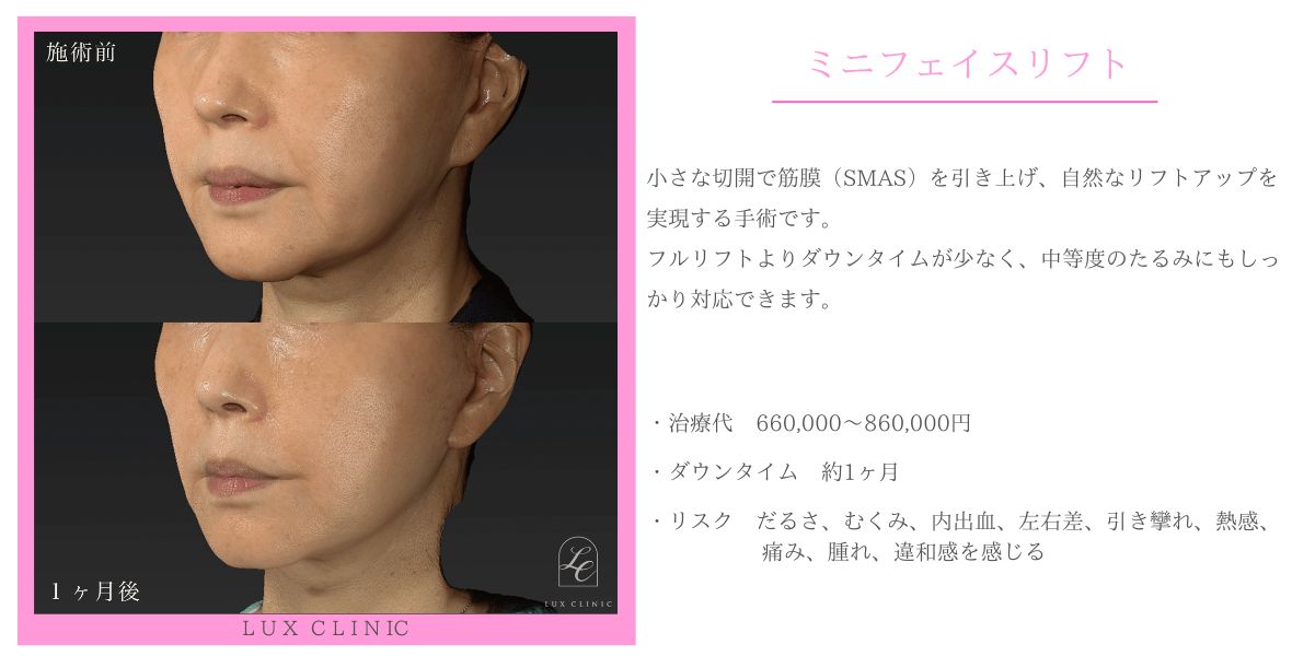 ミニフェイスリフト