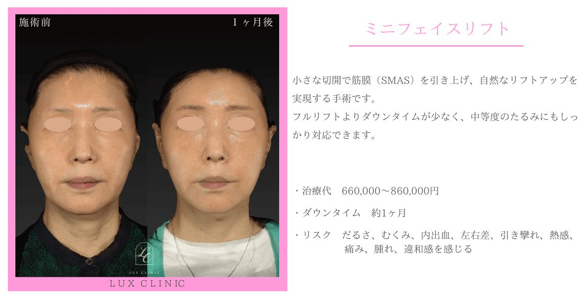 ミニフェイスリフト