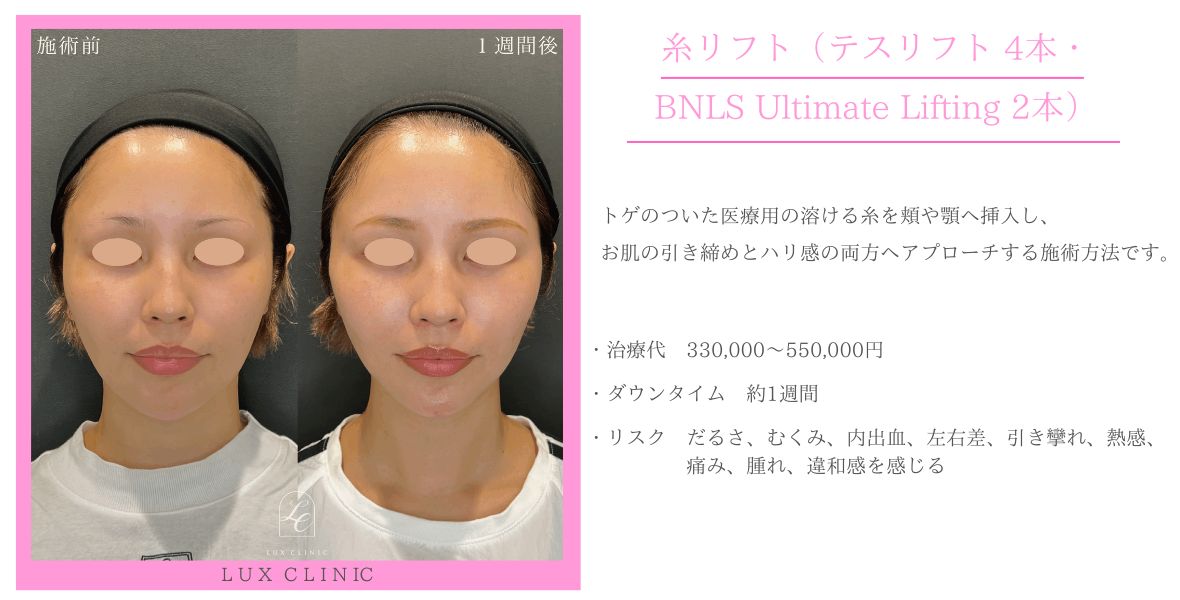 糸リフト テスリフト BNLS Ultimate Lifting