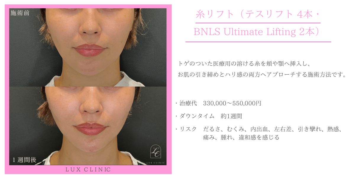 糸リフト テスリフト BNLS Ultimate Lifting