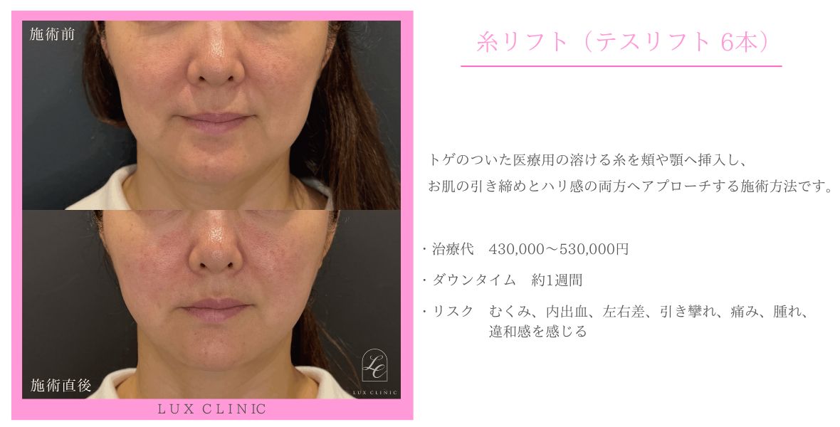 糸リフト テスリフト