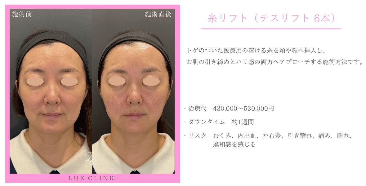 糸リフト テスリフト