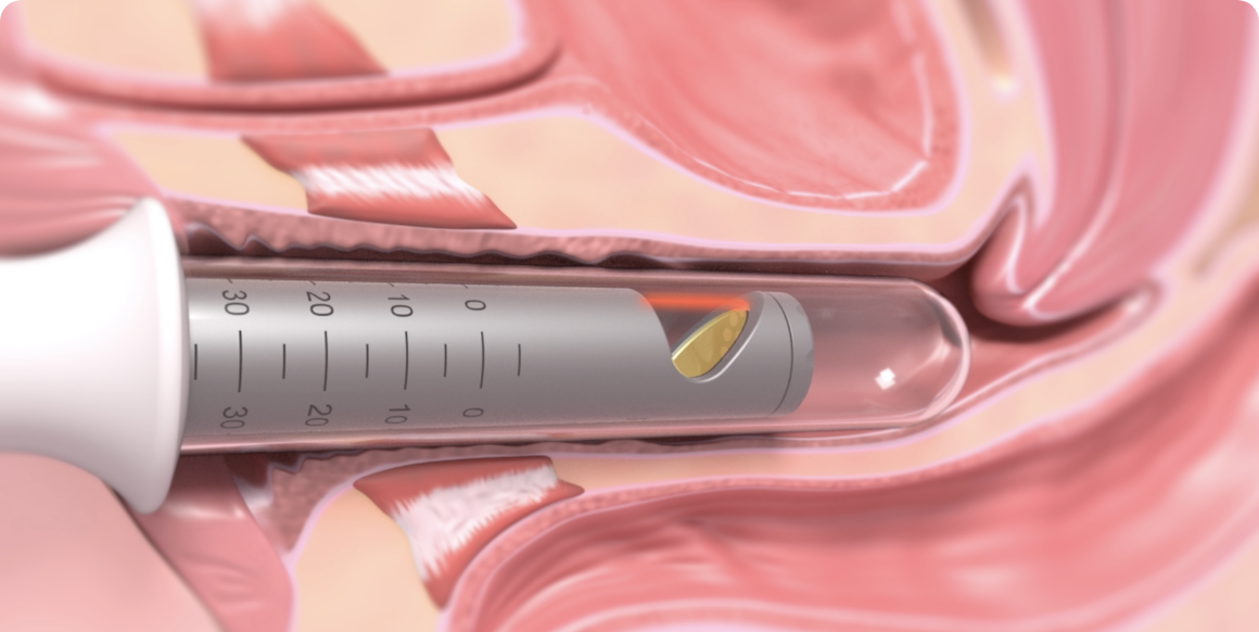 インティマレーザー