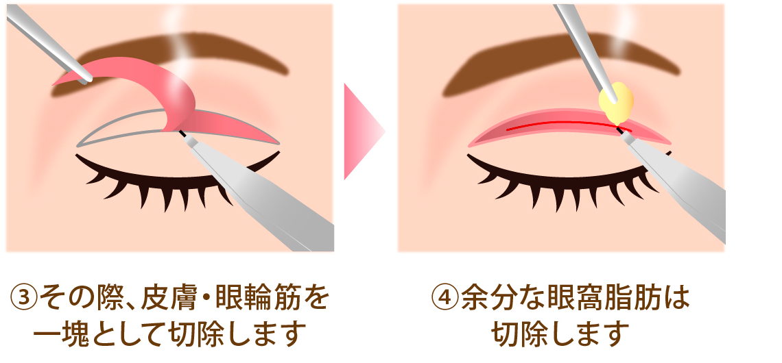 クイックベーシック法2点とめ