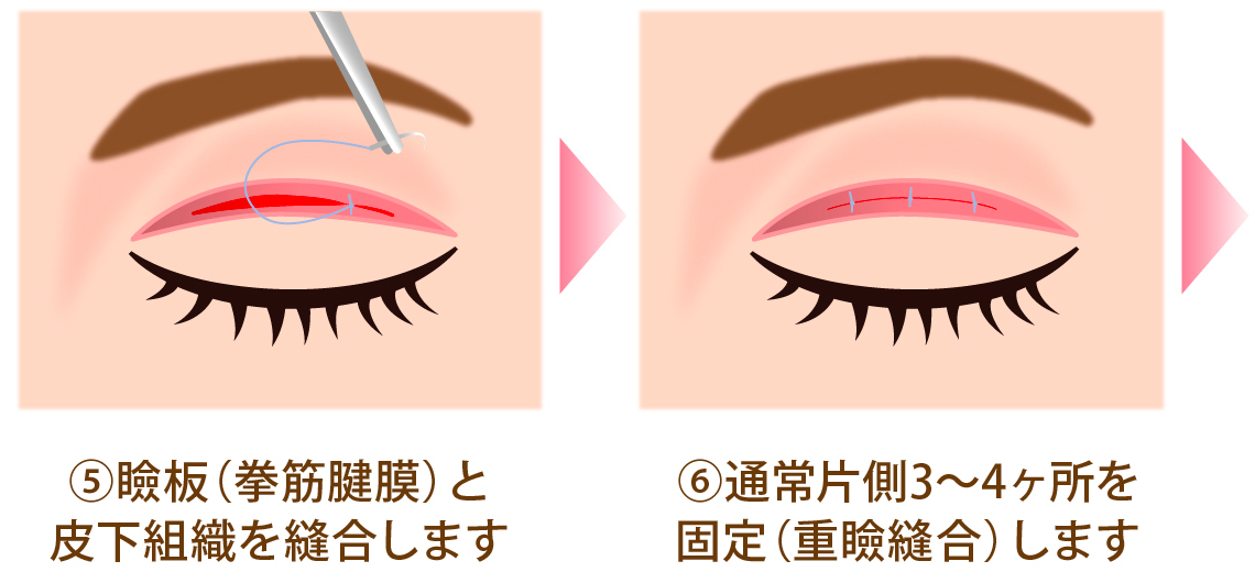 クイックベーシック法1点とめ