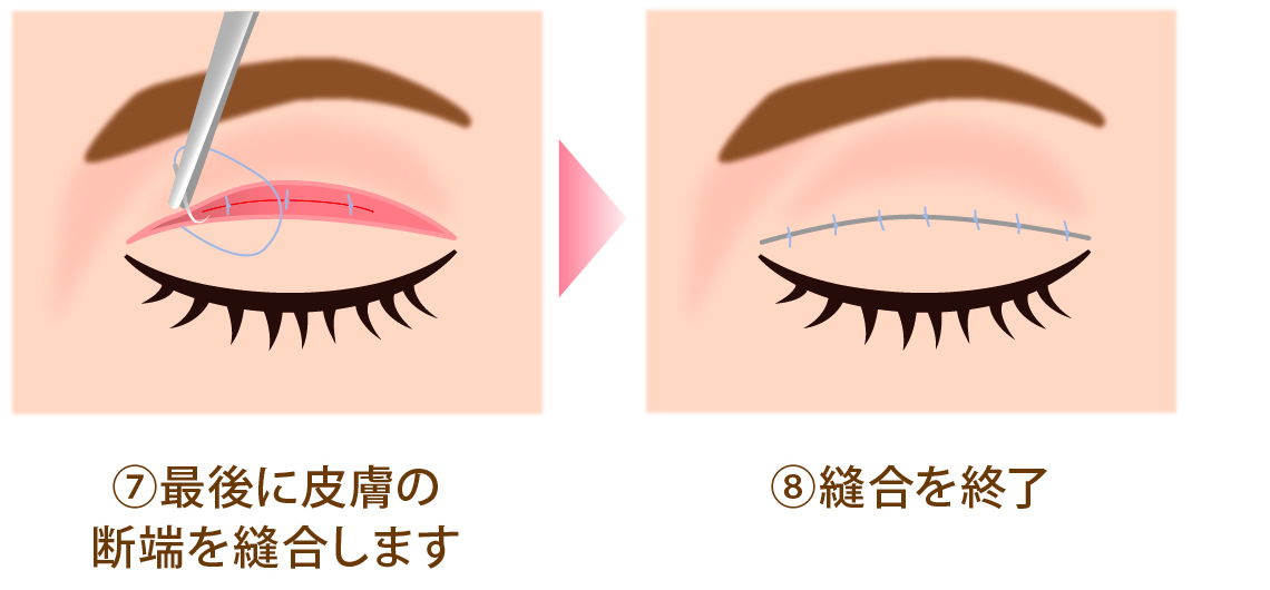 クイックベーシック法2点とめ