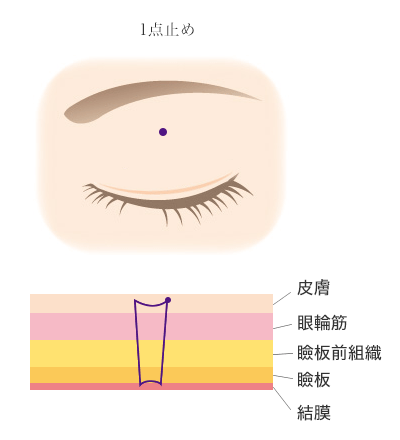 クイックベーシック法1点とめ
