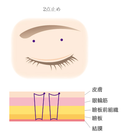 クイックベーシック法2点とめ