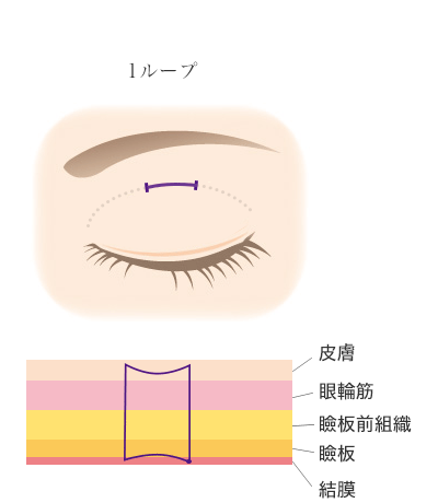 ルクスプレミアム法1ループ