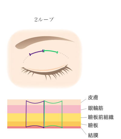 ルクスプレミアム法2ループ