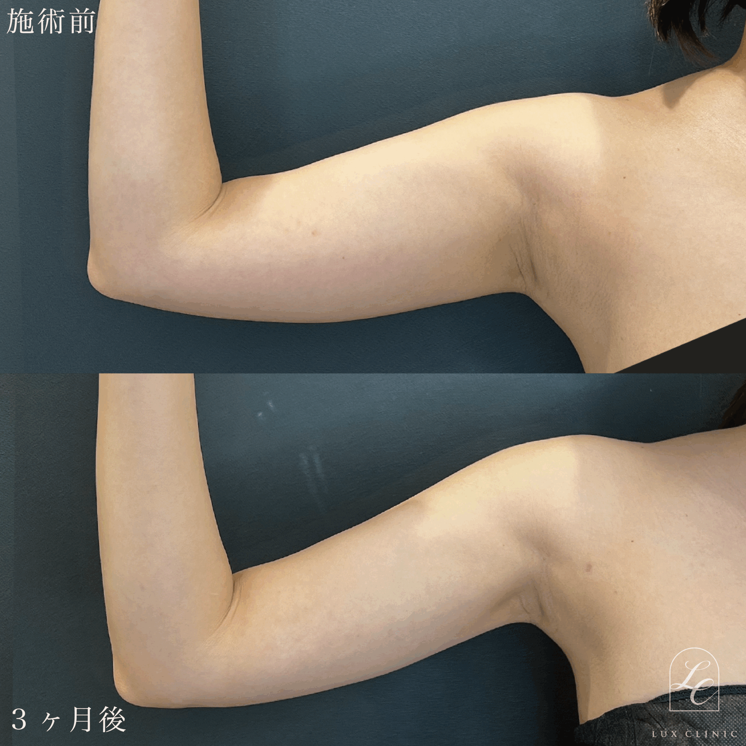Ultra-Z 脂肪吸引 ＜二の腕（後面）・肩・ブラ上＞