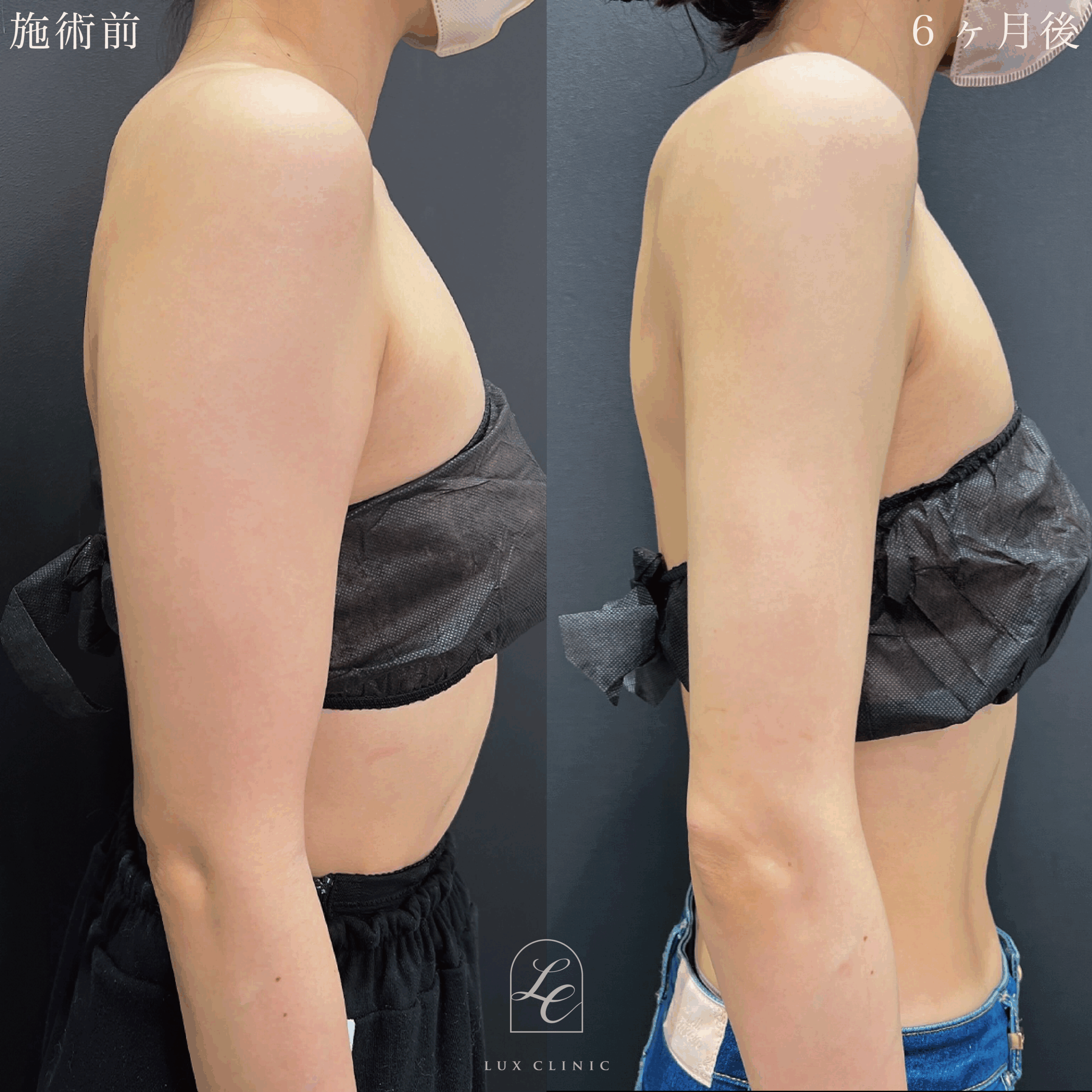 Ultra-Z 脂肪吸引 ＜二の腕（後面）・肩・肩甲骨横＞