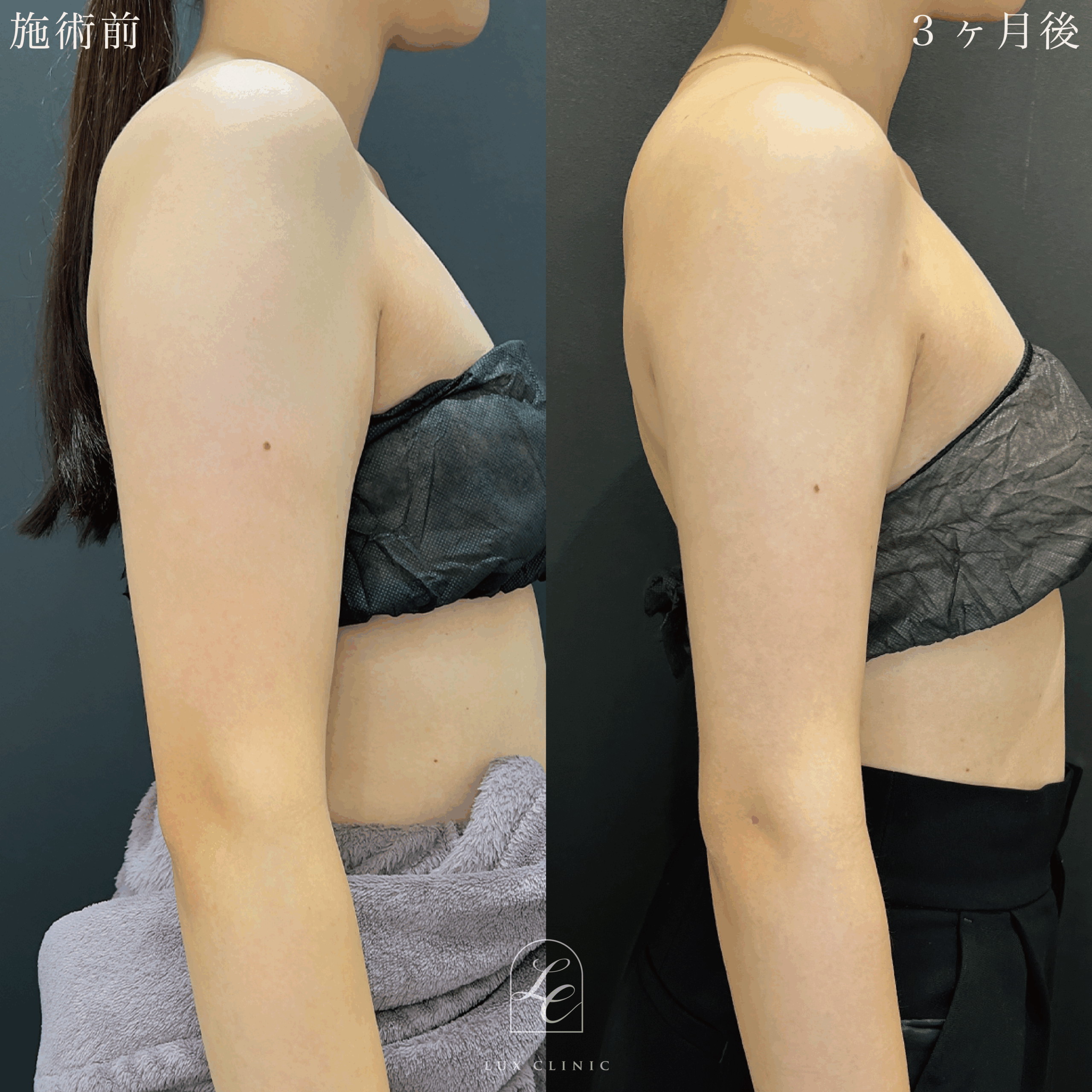 Ultra-Z 脂肪吸引 ＜二の腕（全周）・肩＞