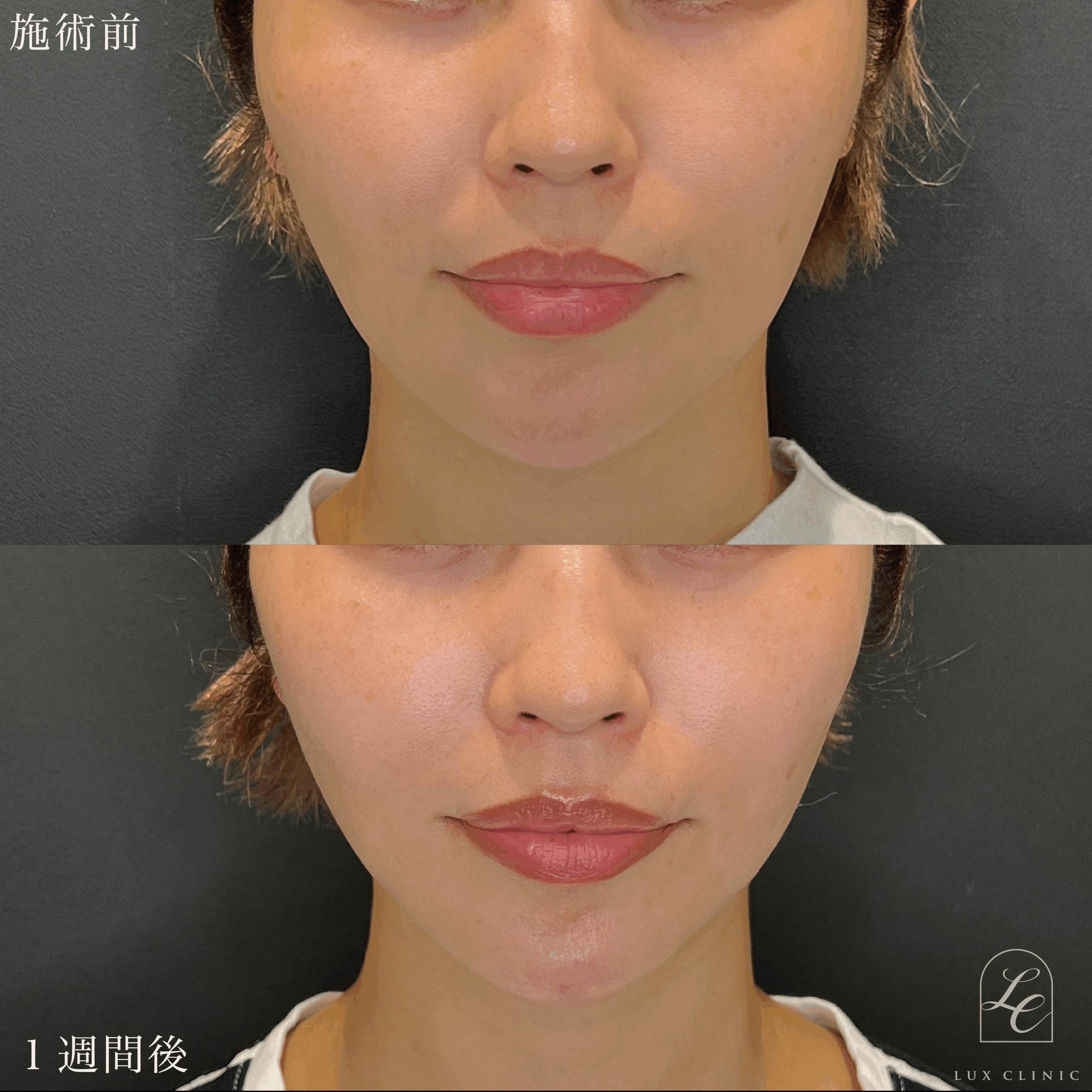 糸リフト（テスリフト 4本・BNLS Ultimate Lifting 2本）