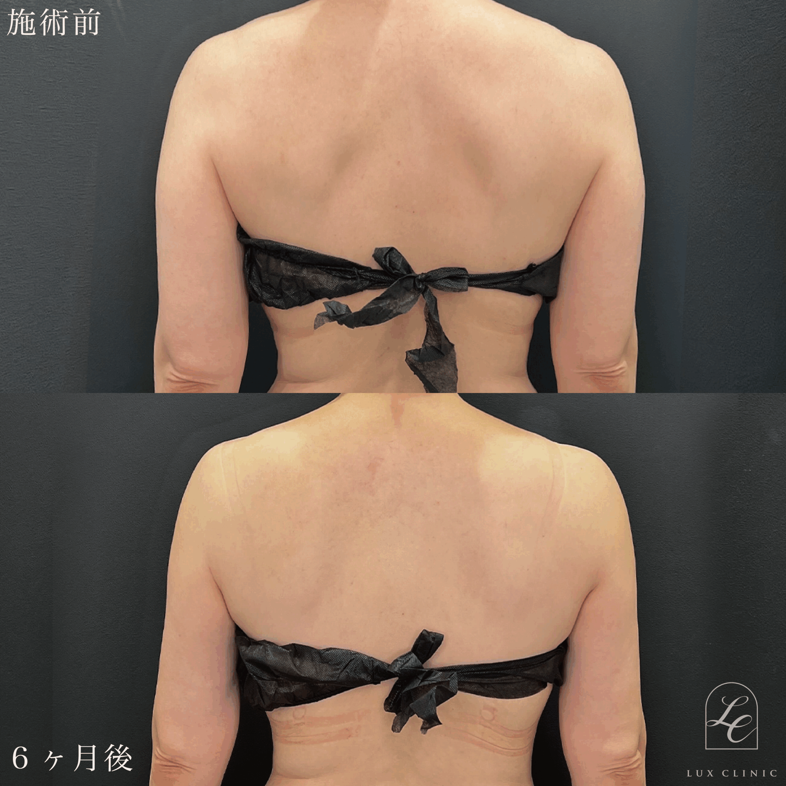 Ultra-Z 脂肪吸引 ＜二の腕（後面）・肩・肩甲骨横＞