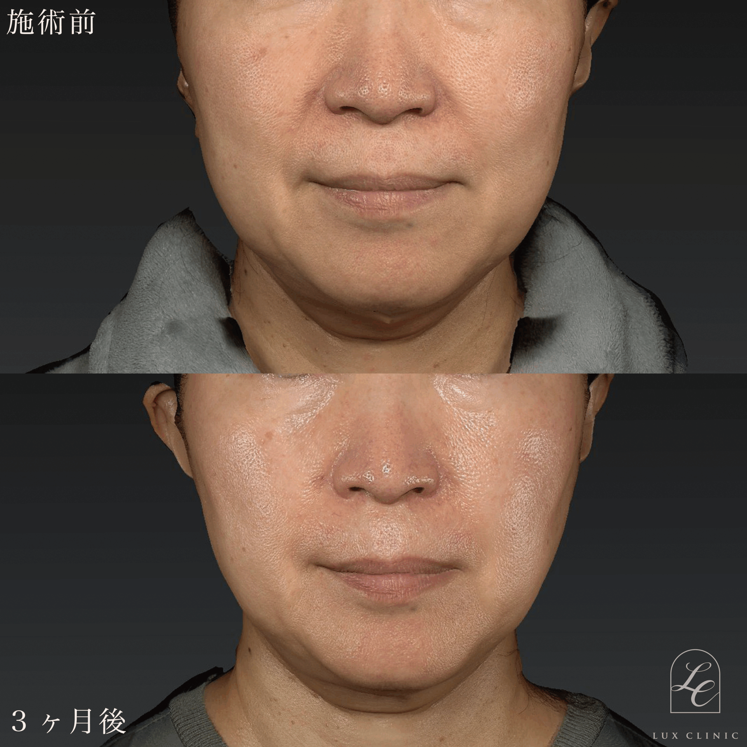 糸リフト（テスリフト 10本 ・ BNLS Ultimate Lifting 4本）