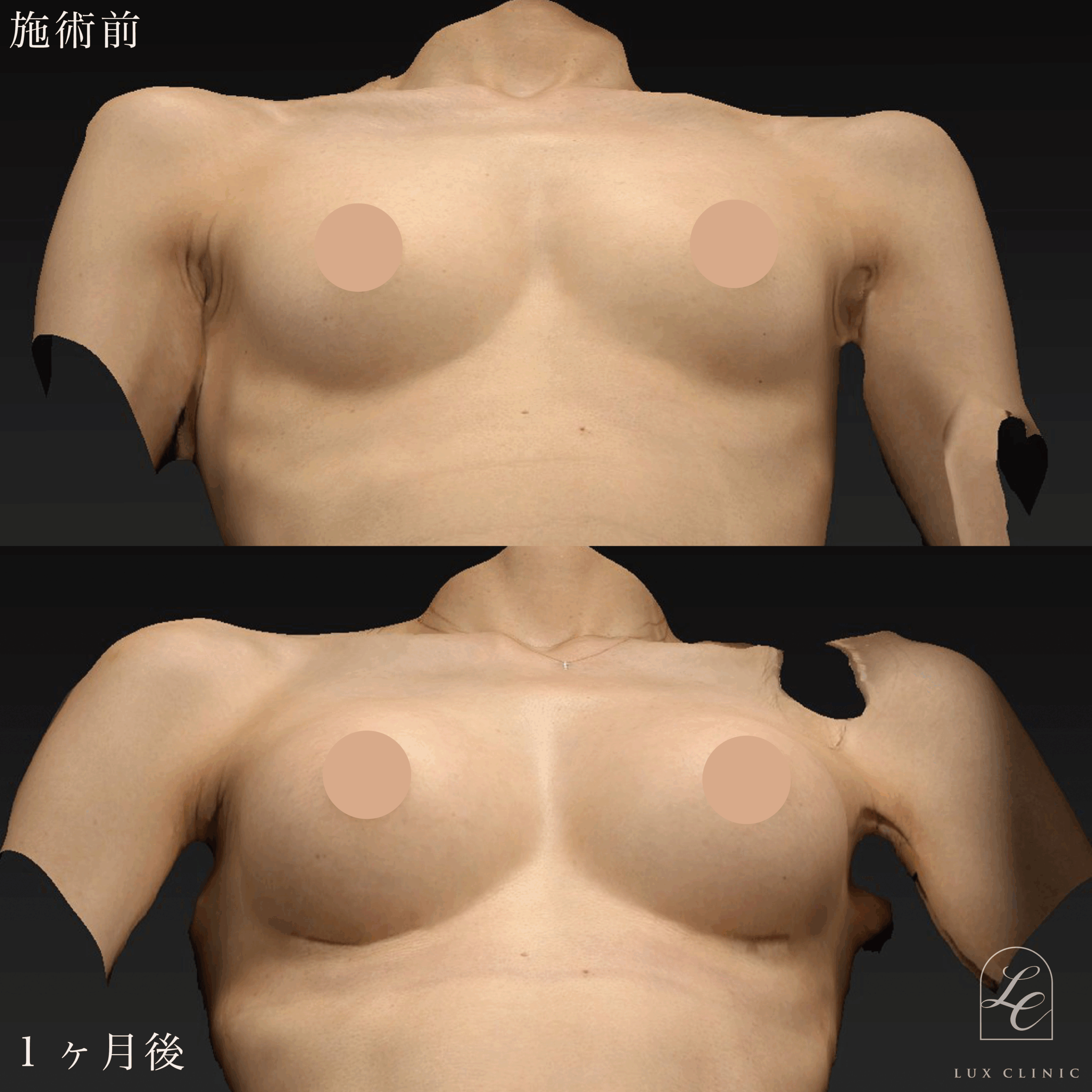 シリコンバッグ豊胸（乳腺下/腋窩法）motiva ergonomix2 210cc demi