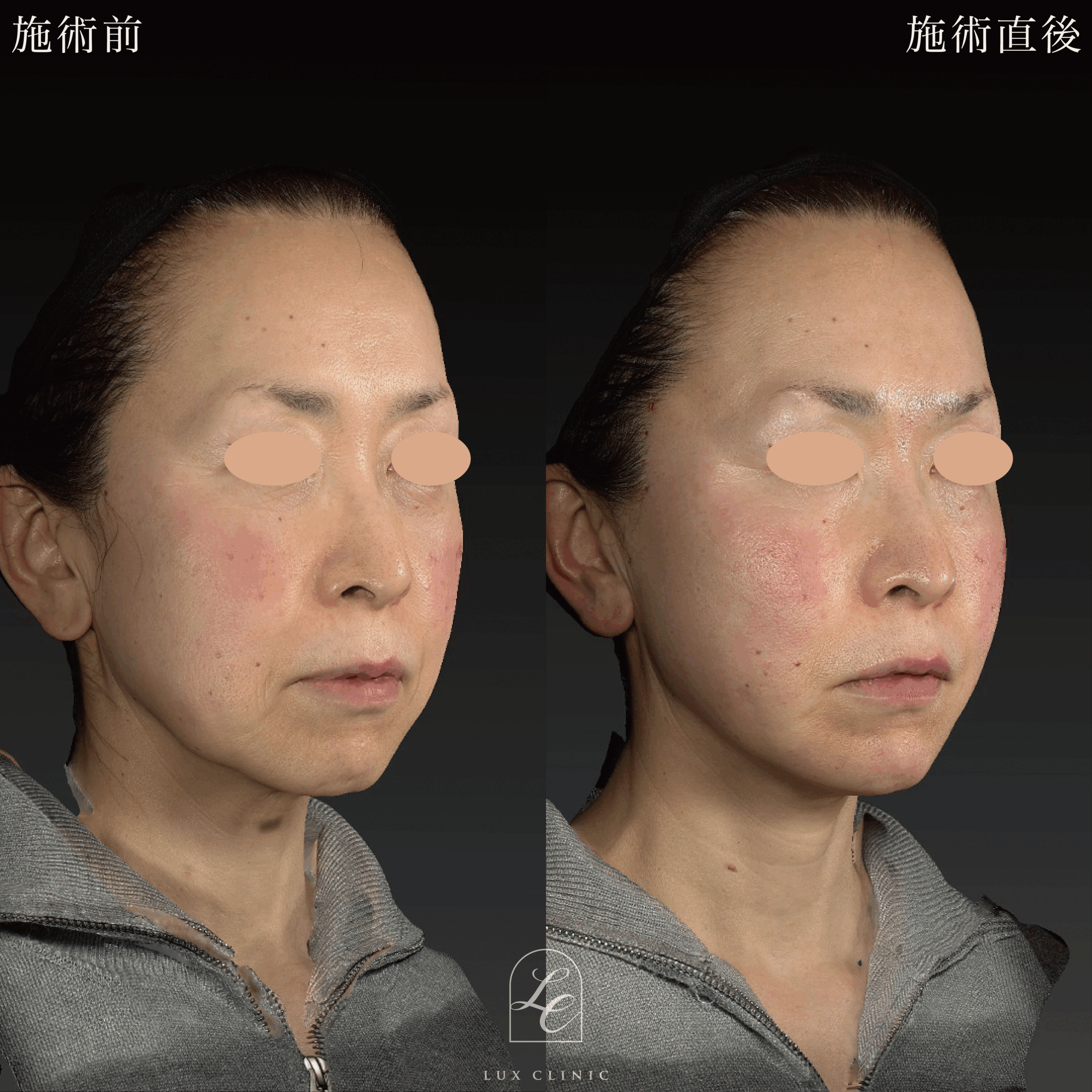 糸リフト（テスリフト 10本）＋ ヒアルロン酸（レスチレン） 6本 ＜額・ほうれい線・あご＞