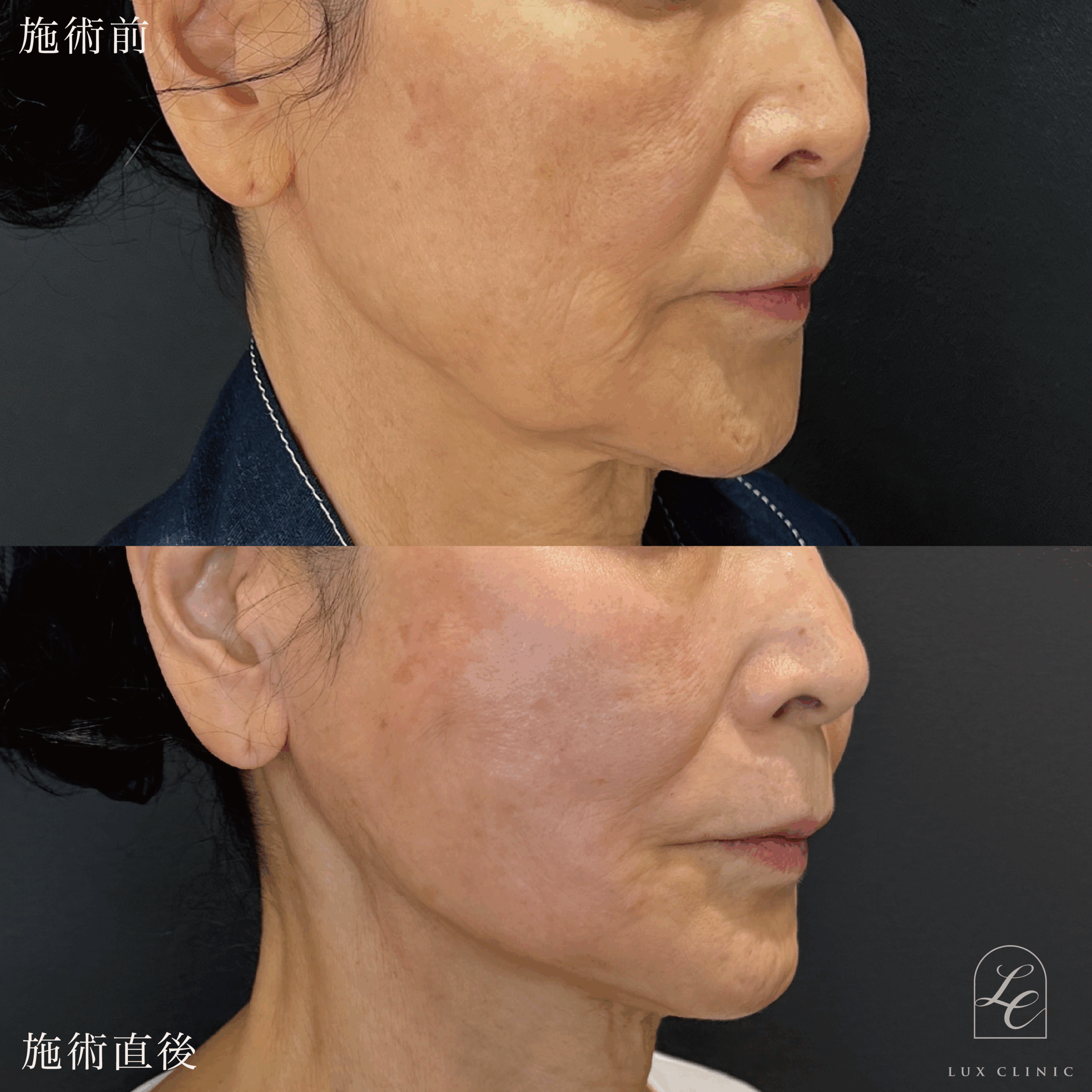 糸リフト（フィオラスレッドFL 4本）＋ ヒアルロン酸（ニューラミス）2本 ＜ほうれい線・口横・こめかみ＞