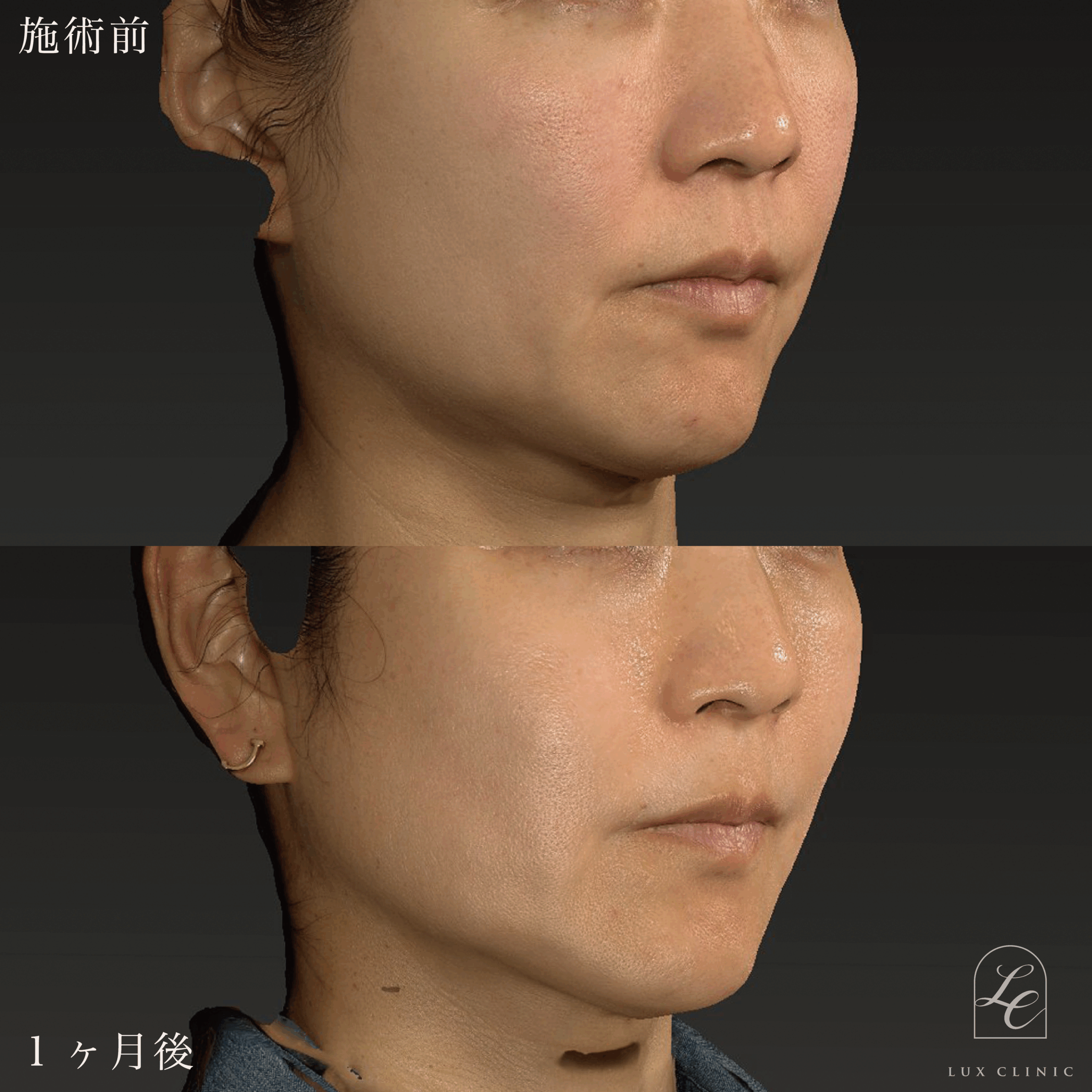 糸リフト（フィオラスレッドFL 4本）