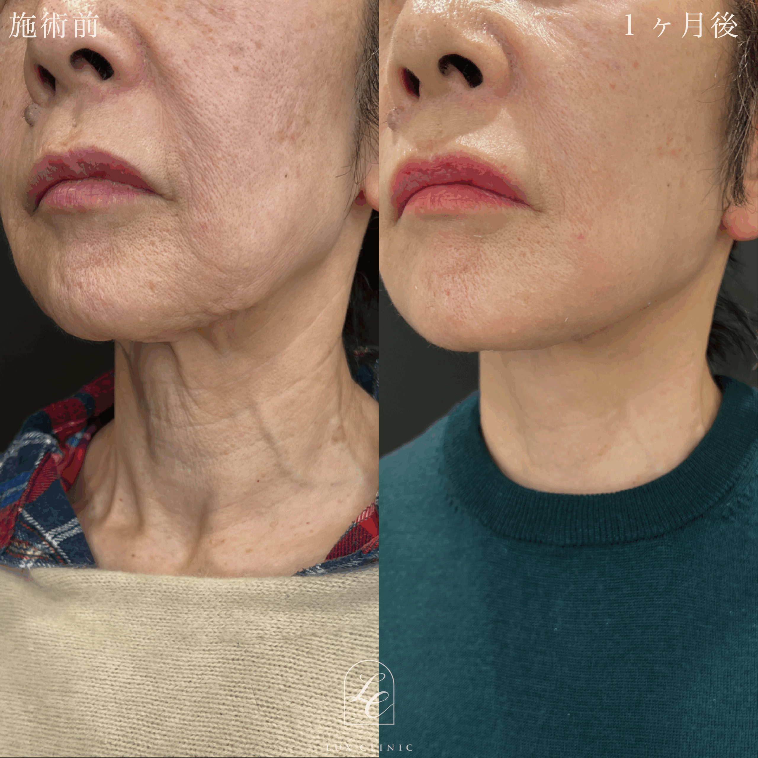 フェイスネックリフト