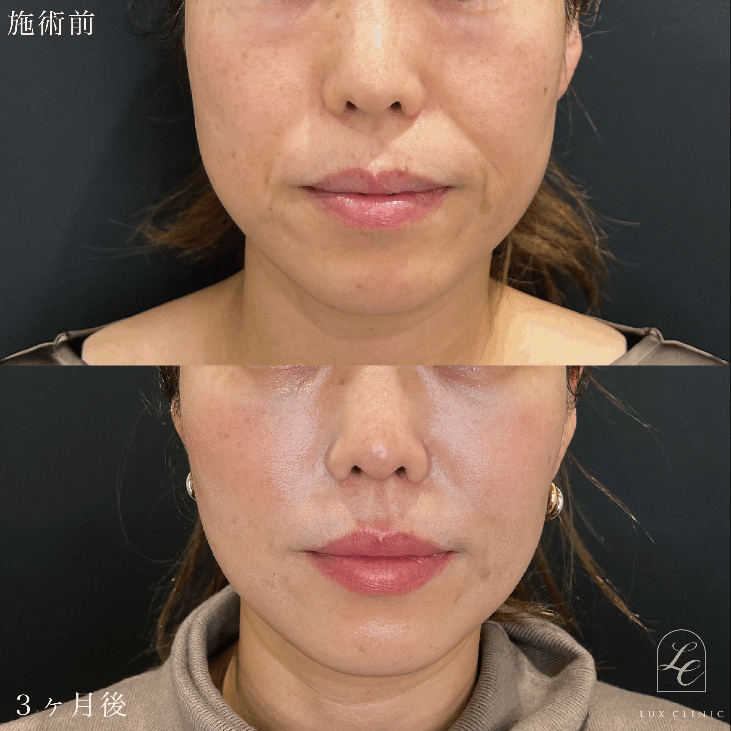 糸リフト（テスリフト 10本）＋ エラボトックス