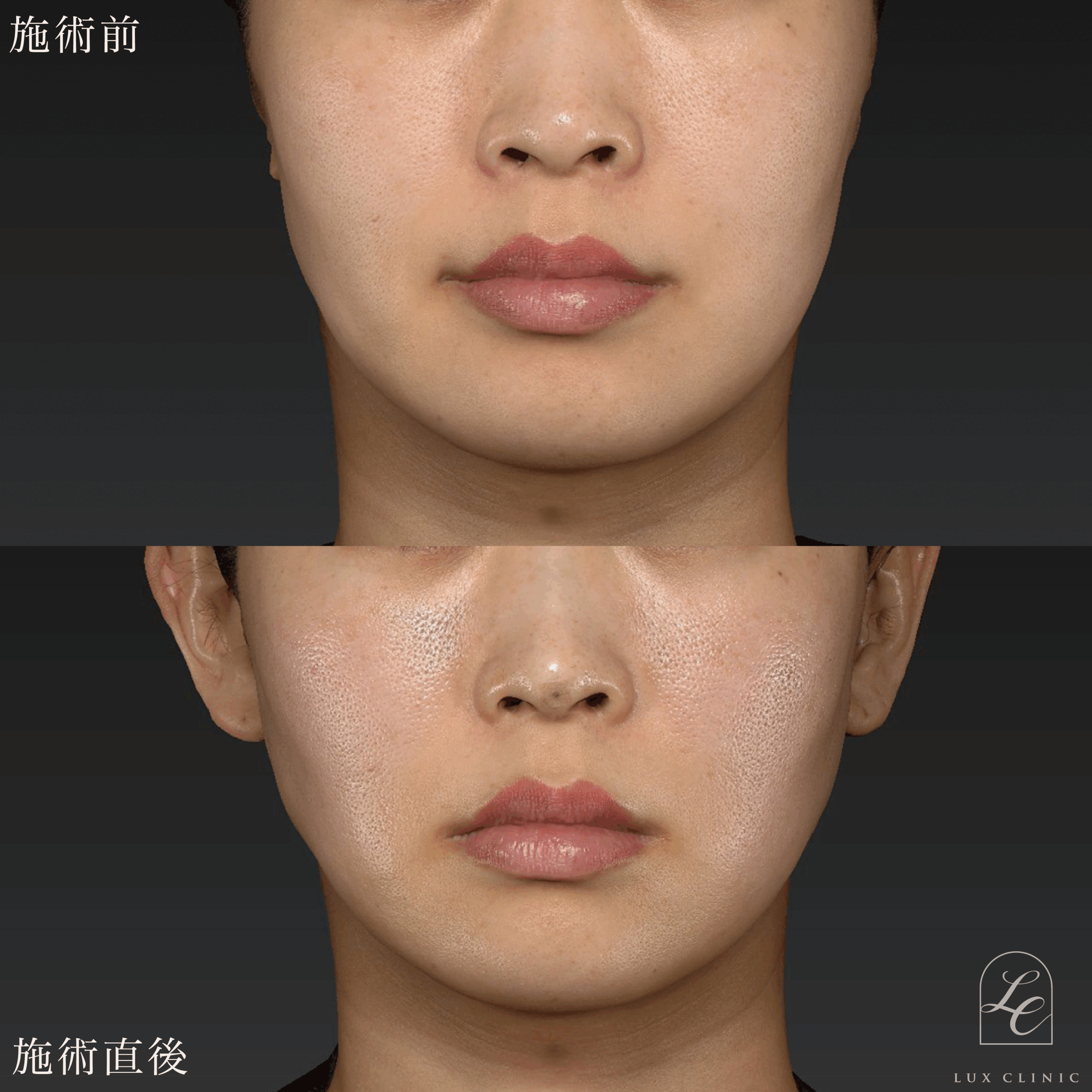 糸リフト（テスリフト 10本）