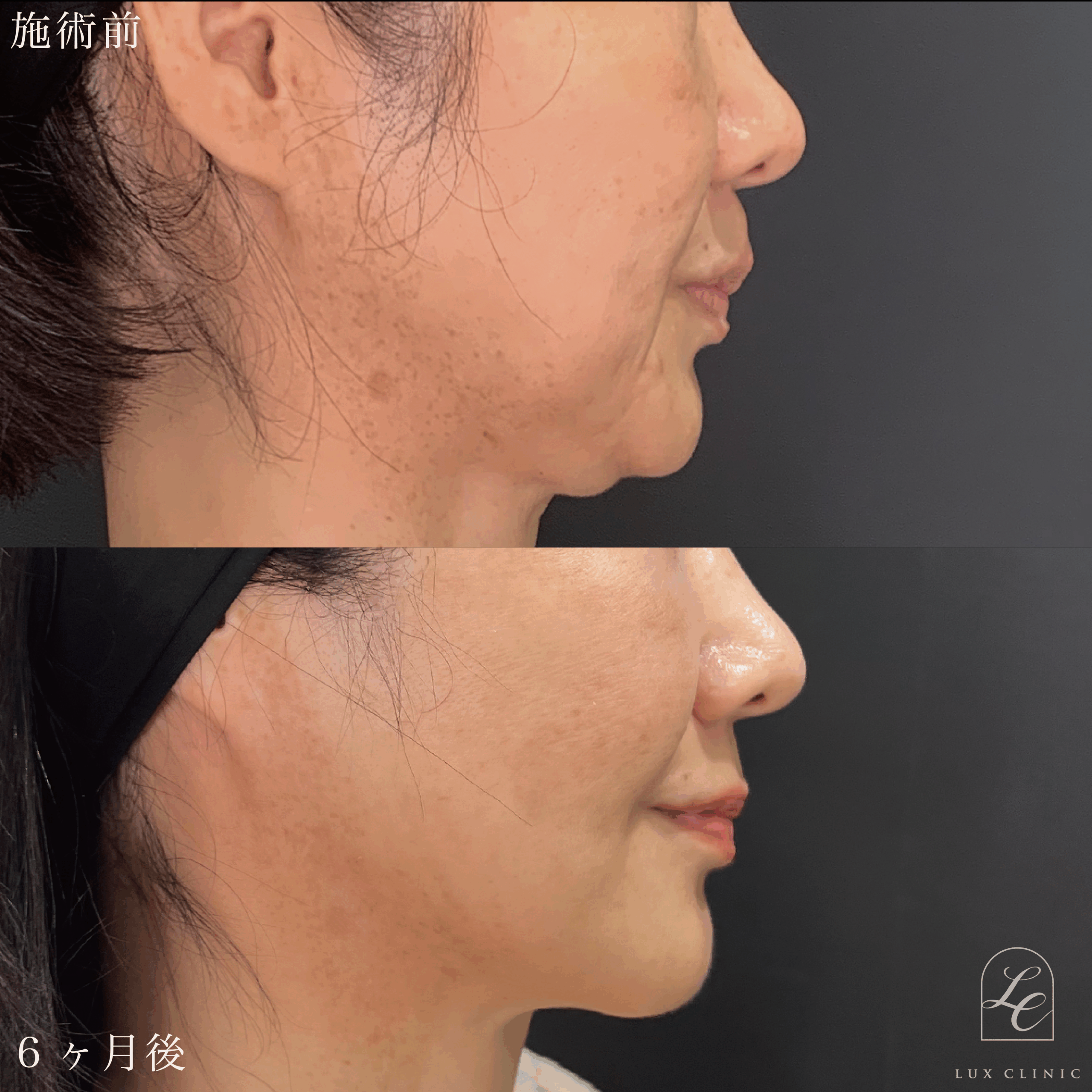 Ultra-Z 脂肪吸引＜頬・あご下＞＋ 糸リフト（テスリフト 10本）