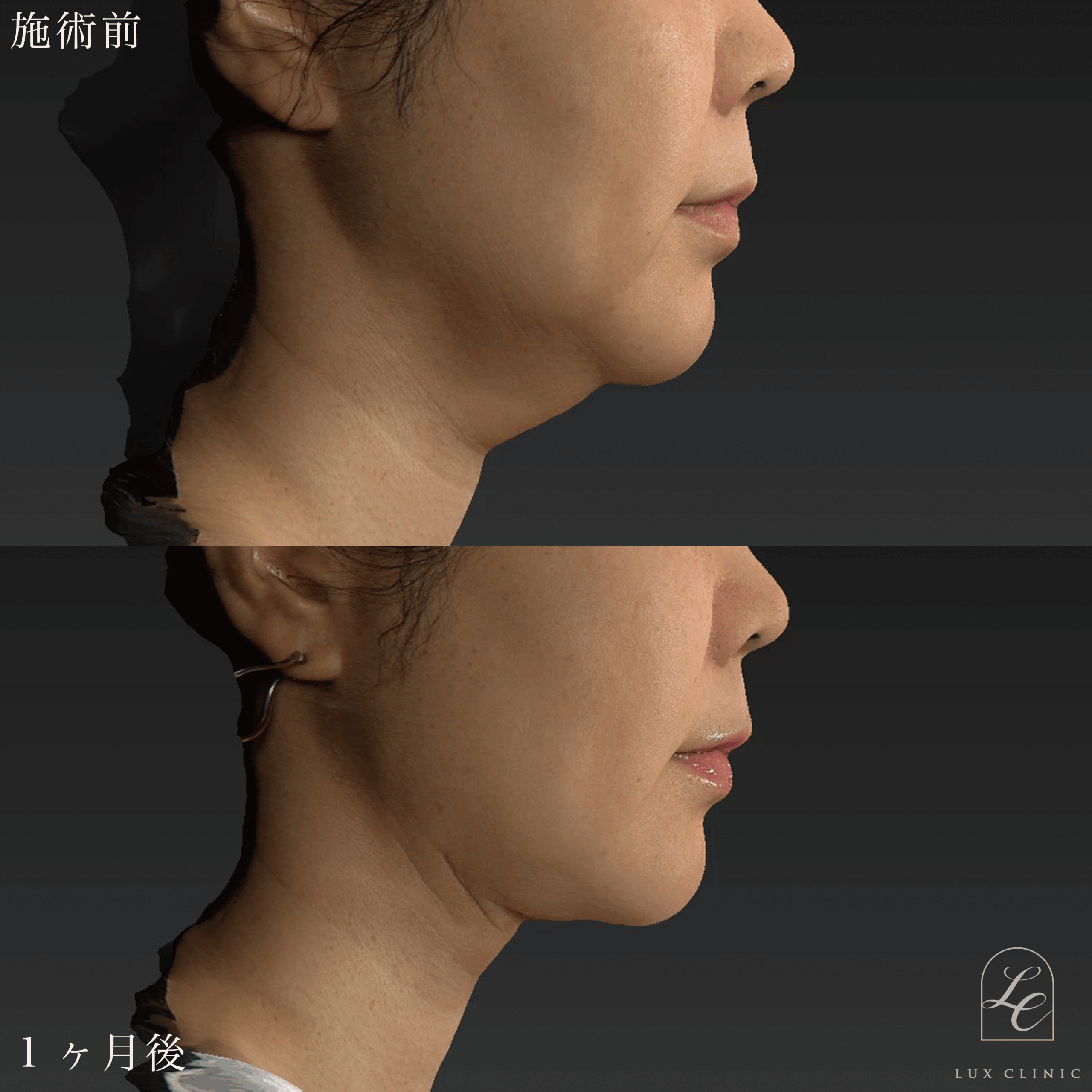 Ultra-Z 脂肪吸引＜あご下＞＋ 糸リフト（テスリフト 10本・BNLS Ultimate Lifting 4本）