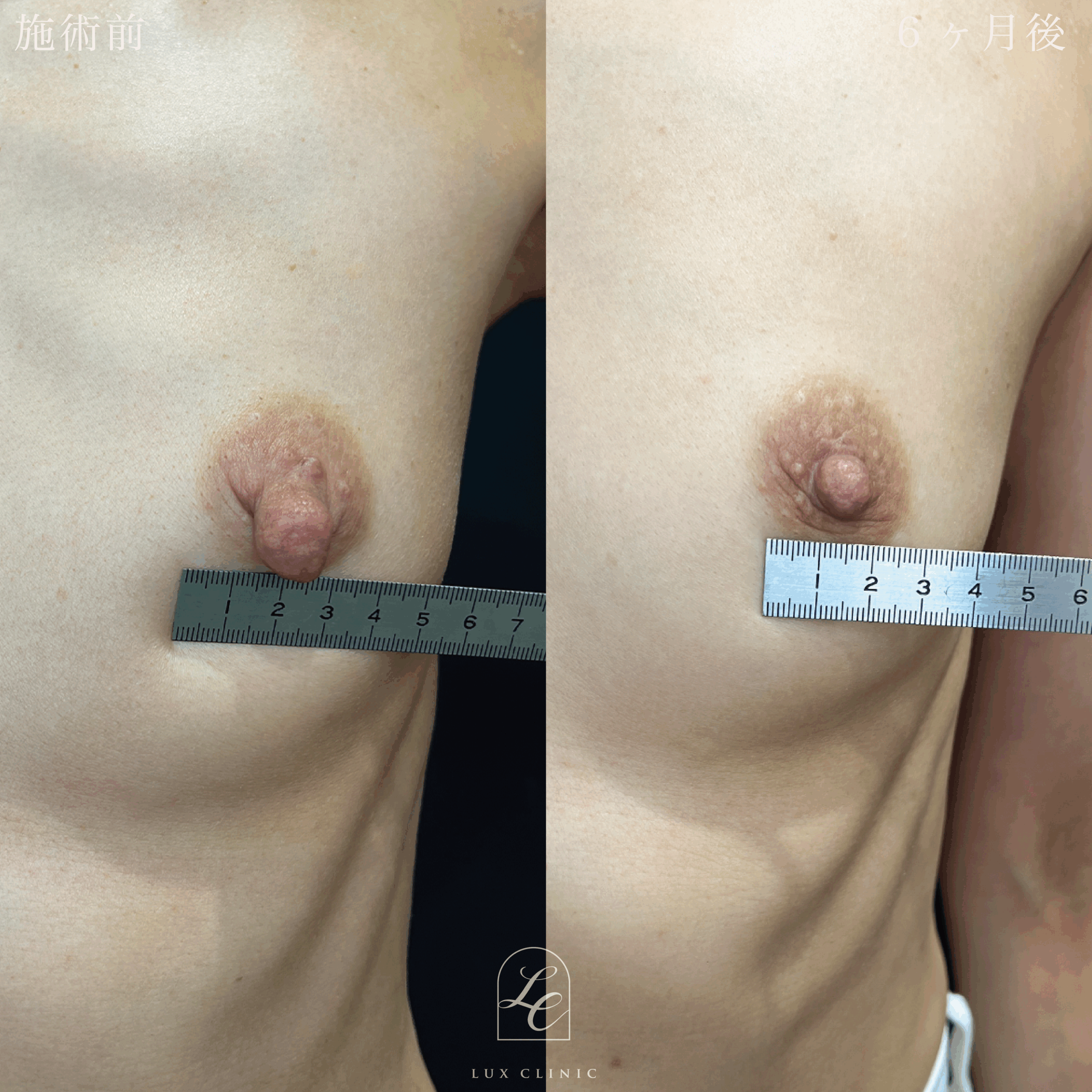 乳頭縮小術（乳管温存あり）＋ モントゴメリー腺切除 5個