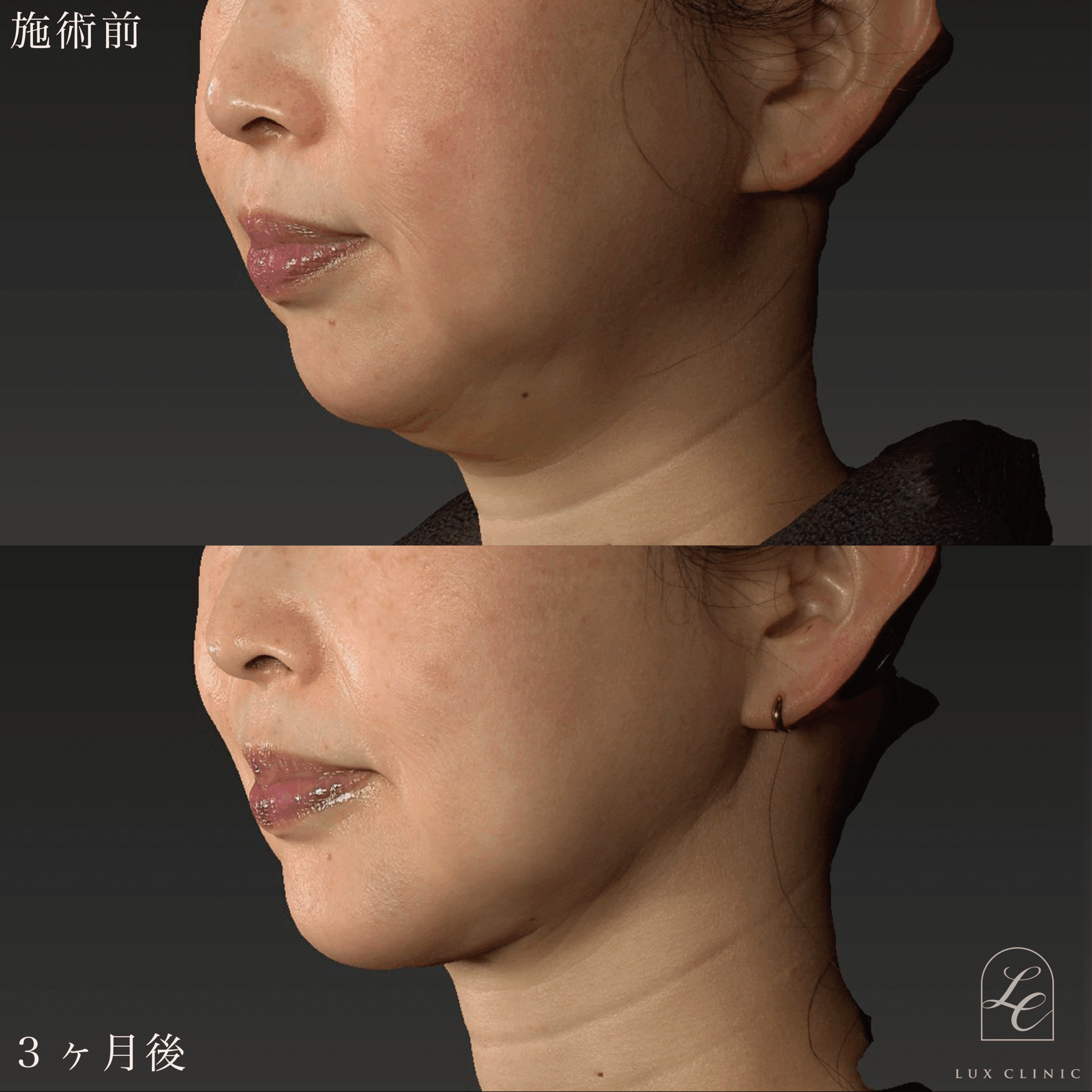 Ultra-Z 脂肪吸引＜頬・あご下＞ ＋ 糸リフト（テスリフト 10本・BNLS Ultimate Lifting 4本）＋ ヒアルロン酸 （テオシアル ３本＜ほうれい線・口横・ゴルゴ・あご＞）