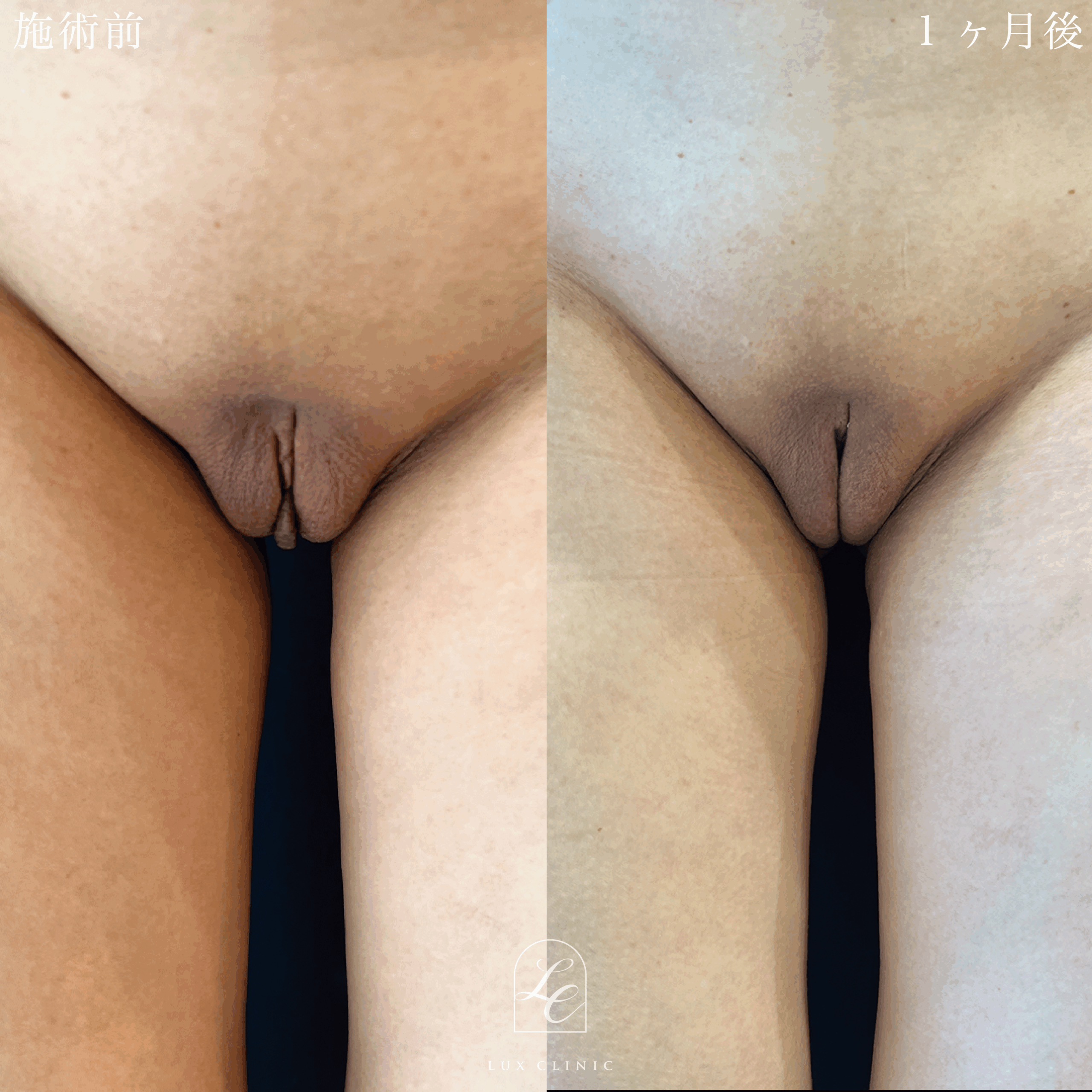 小陰唇縮小術 インスィーム法（抜糸なし）