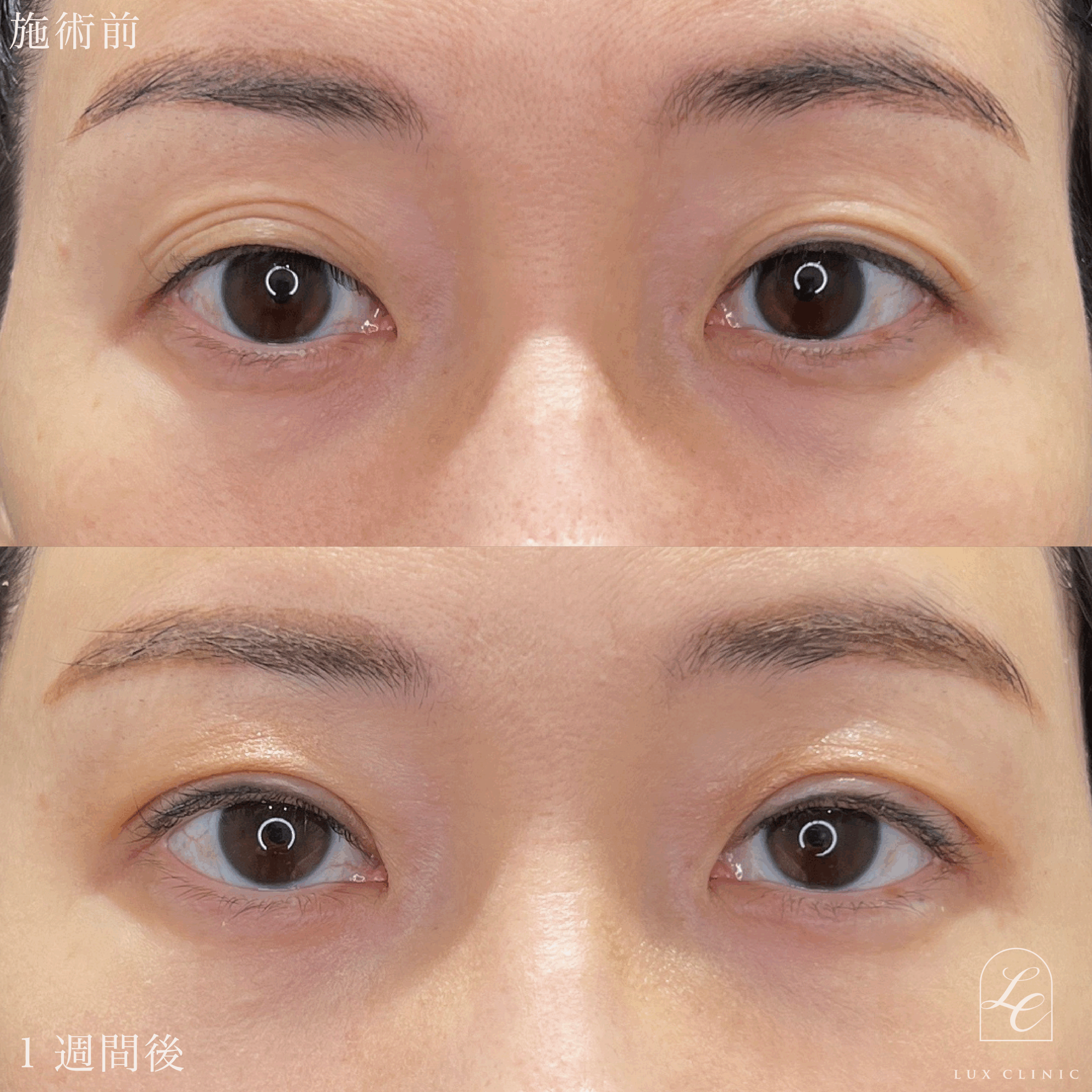 二重埋没法（クイックベーシック法 3点留め）