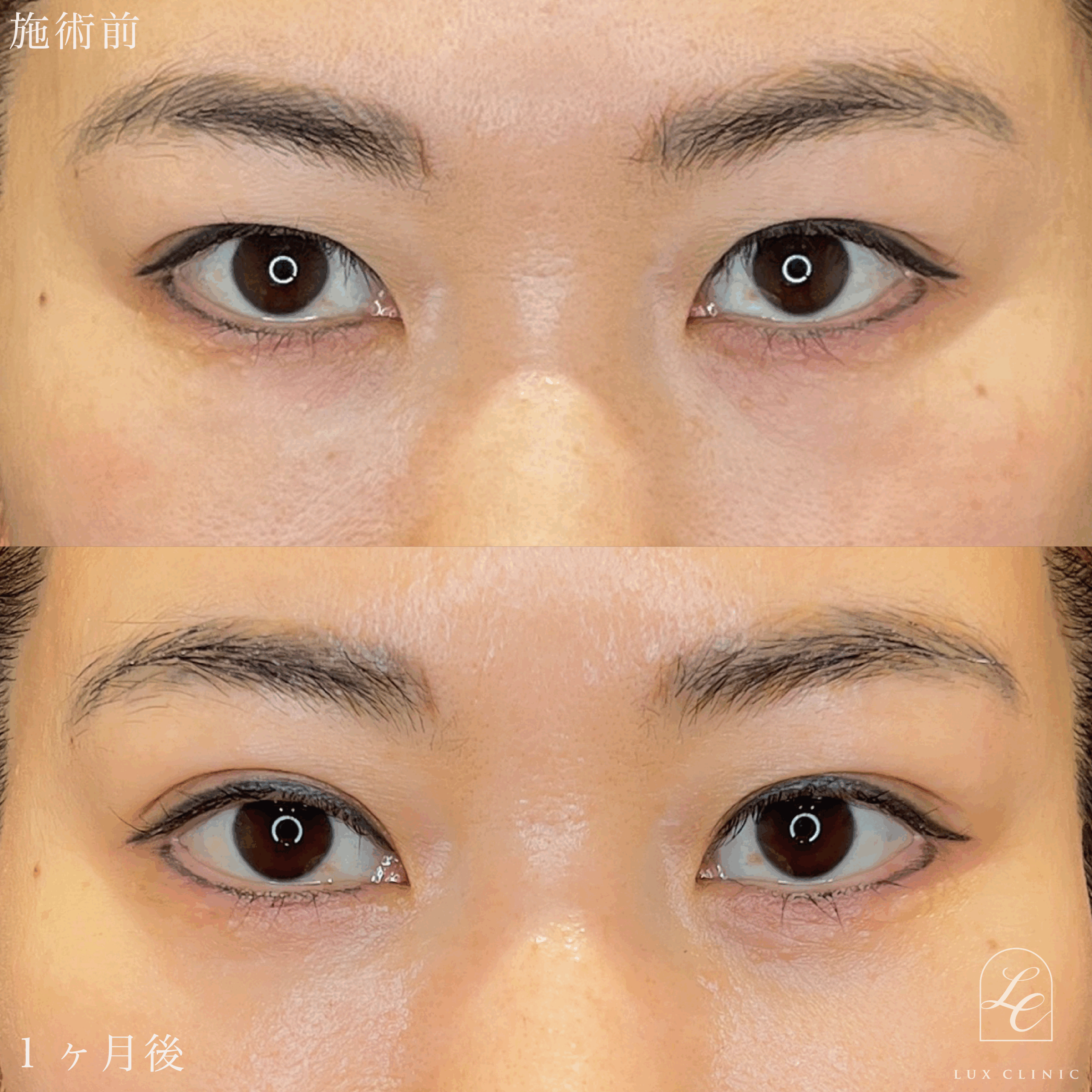 二重埋没法（クイックベーシック法 3点留め） ＋ 目の下のクマ取り、ふくらみ取り（脱脂）術